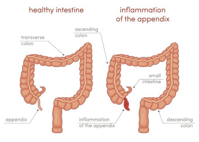 Normal appendix vs. inflamed appendix