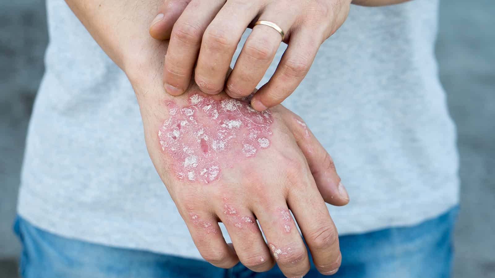 Atopic Dermatitis