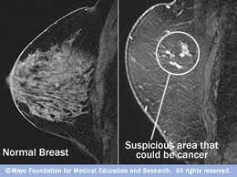 an MRI image and an x-ray image of cancer-infected breasts.