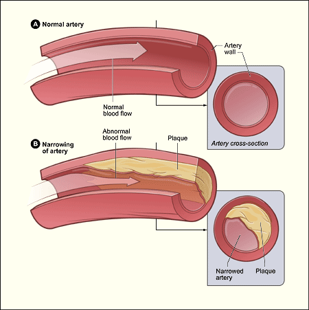 Normal Artery and Affected Artery.