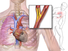 Discomfort in the chest caused by angina.