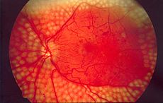 Diabetic retinopathy