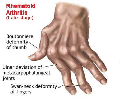  a person’s hand suffering from rheumatoid arthritis a form of rheumatism.