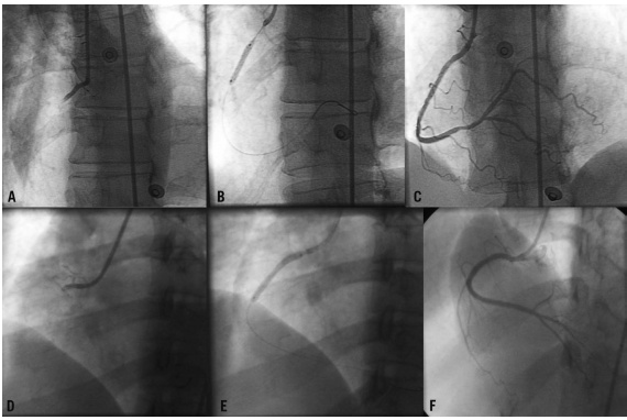 Delay in diagnosis and treatment in women with the STEMI symptoms.