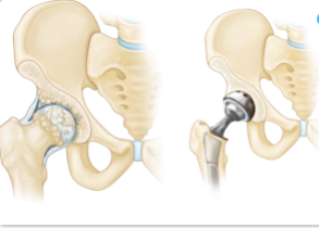 Diagram showing joint replacement surgery 