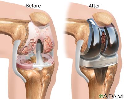 Diagram showing joint replacement surgery 