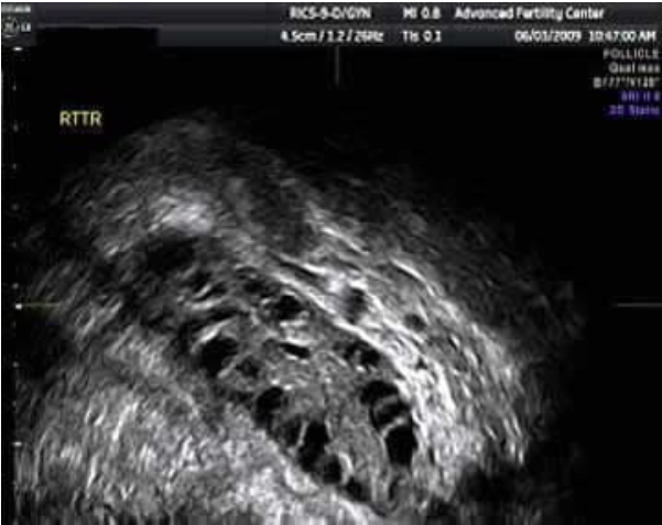 Polycystic ovary with many antral follicles