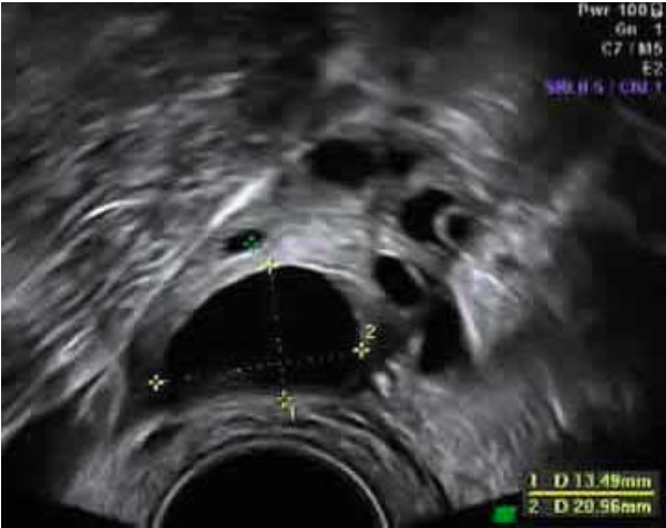 Normal ovary with a single mature follicle – yellow cursors are measuring the follicle