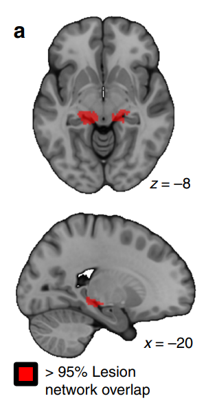 The lesion network overlap created by the researchers demonstrates that in 95% of the cases, the lesion site has a functional connection with the junction of the retrosplenial cortex and HPC