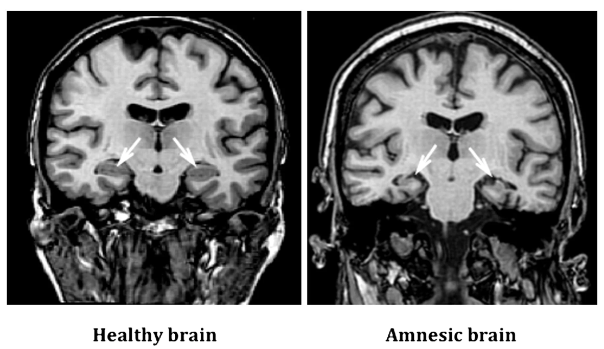 Arrows indicate the hippocampal region, and in the case of amnesia, HPC atrophy is significantly noticeable