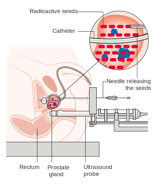 Radiotherapy.